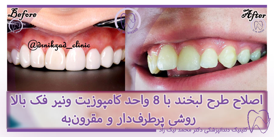 عکس کامپوزیت دندان جلو بالا قبل و بعد
