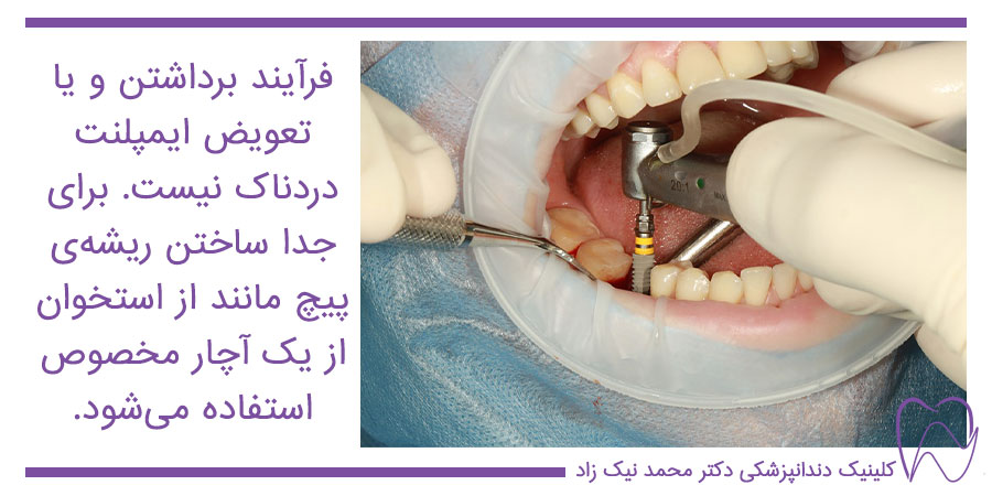 خارج کردن ایمپلنت دندان