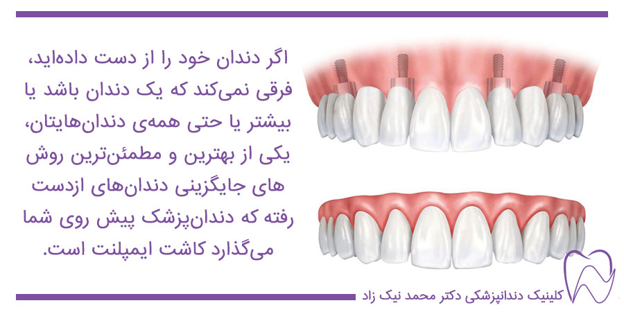 کاشت ایمپلنت برای تمام دندان‌ها