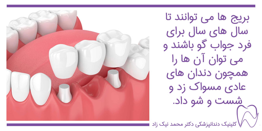 بریج های ثابت دندان