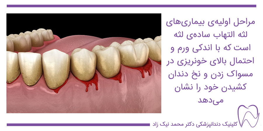 التهاب و خونریزی لثه بعد از مسواک و خمیر دندان