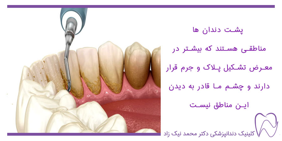 جرم گیری پشت دندان هاتوسط دندان پزشک