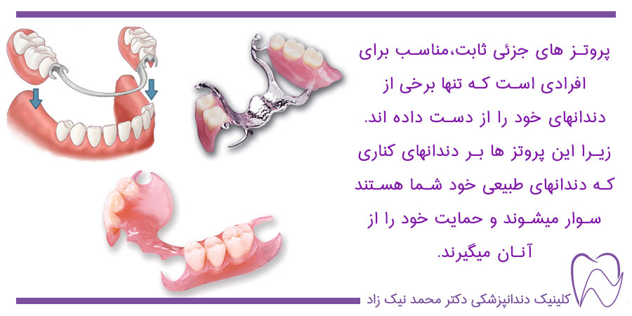 پروتزهای ثابت دندان