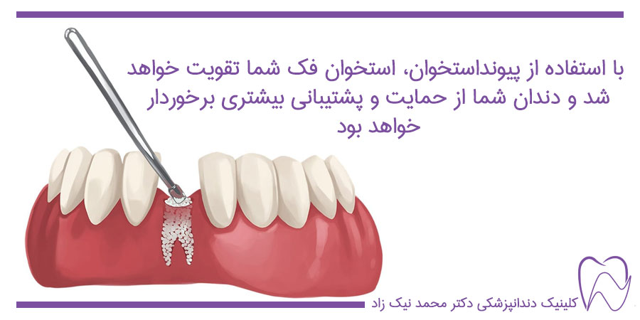 پودر استخوان برای ایمپلنت دندان