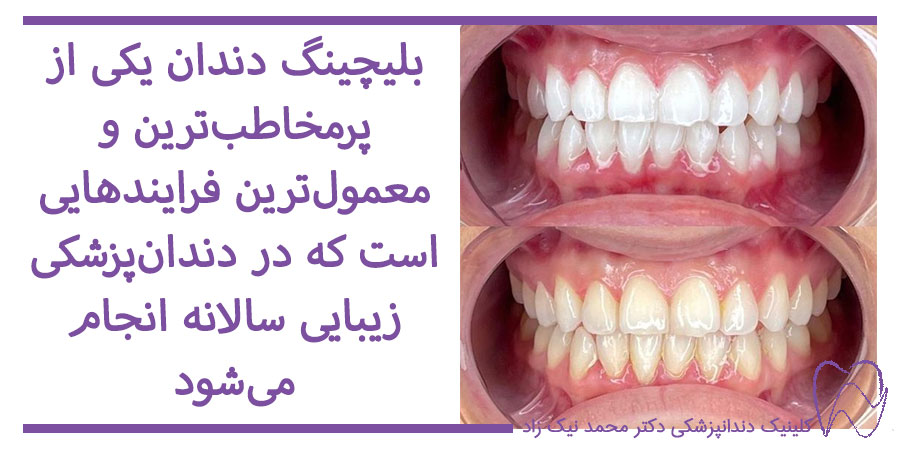 عکس قبل و بعد از بلیچینگ دندان