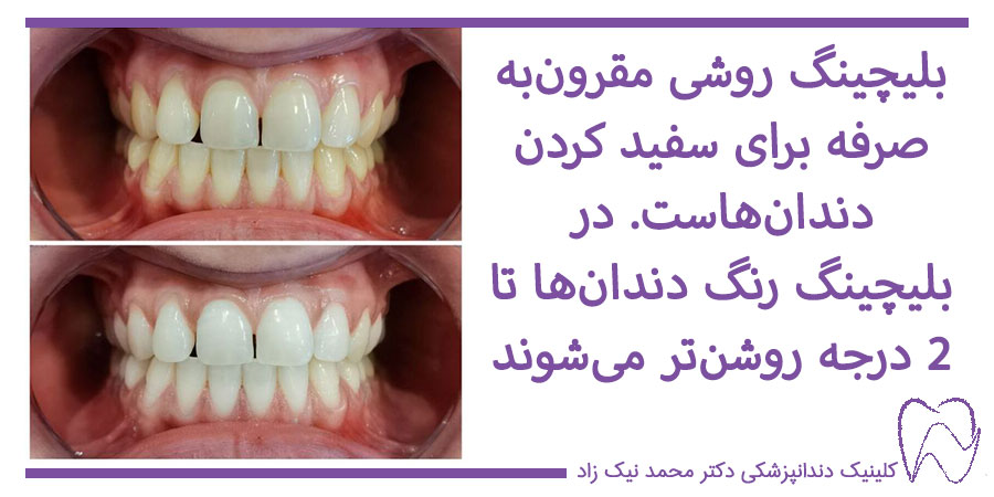 میزان تغییر رنگ دندان بعد از بلیچینگ
