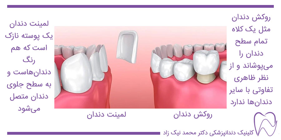تفاوت روکش با لمینت دندان