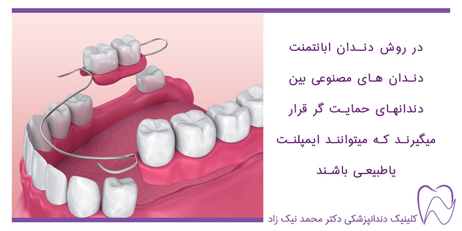 دندانهای مصنوعی بین دندانهای حمایتگر