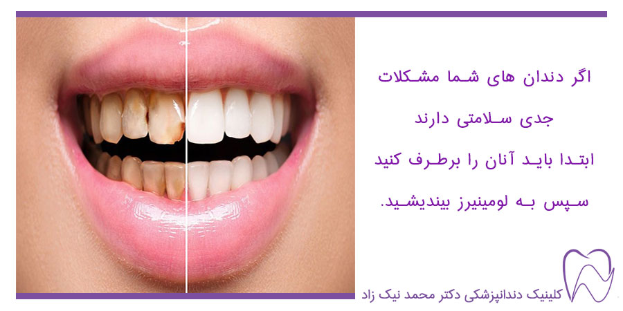 برطرف کردن مشکلات جدی دندان قبل از لومینیرز
