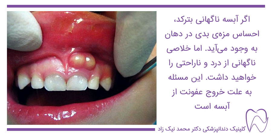 تخلیه عفونت آبسه دندان
