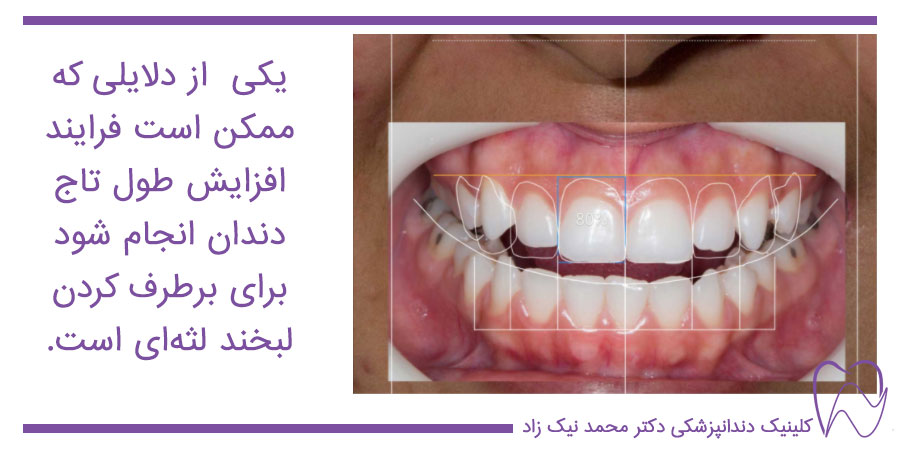 معاینه برای جراحی افزایش طول تاج دندان