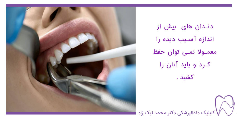 کشیدن دندان- ذندان های اسیب دیده