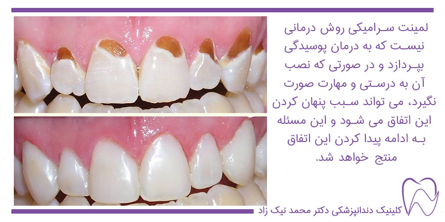 لمینت دندان برای درمان پوسیدگی استفاده نمی‌شود