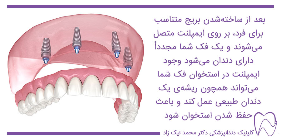 ایمپلنت دندان برای تمام دندان‌ها