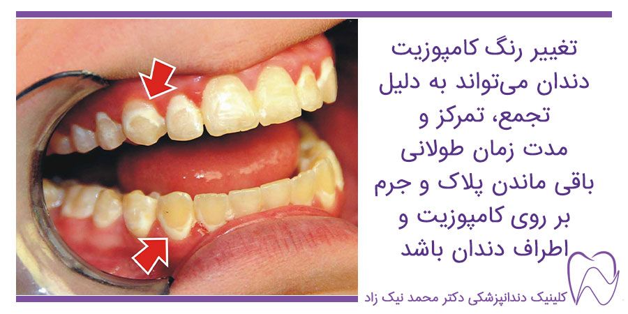 تغییر رنگ کامپوزیت دندان