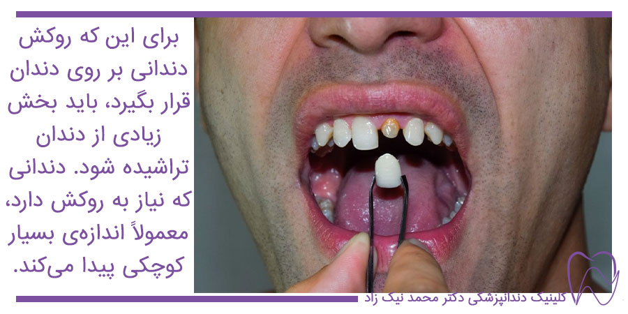 معایب روکش دندان