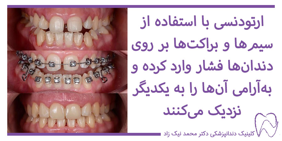 ارتودنسی برای برطرف کردن فاصله بین دندان‌ها