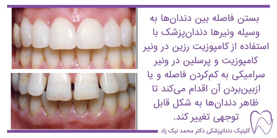 بستن فاصله بین دندانها