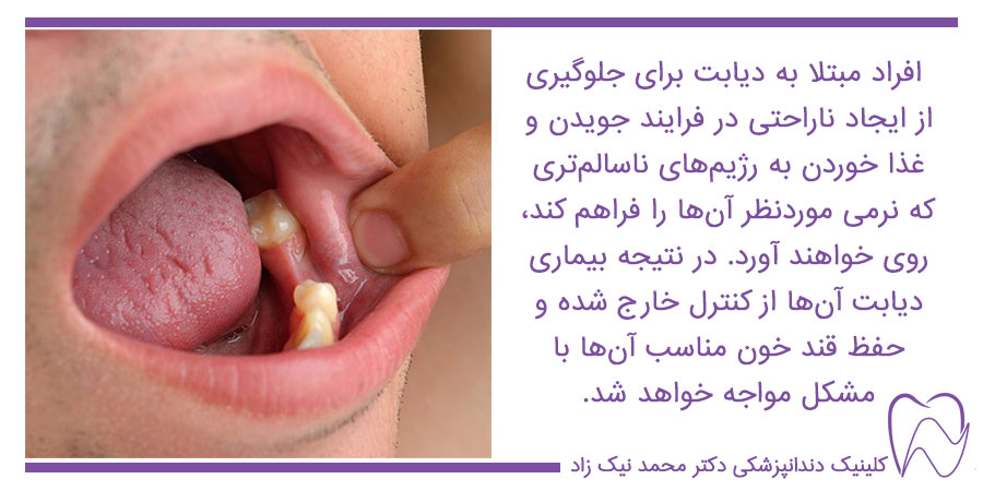 ایمپلنت دندان برای افراد دیابتی