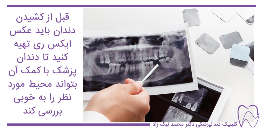 عکس ایکس ری برای آمادگی قبل از کشیدن دندان