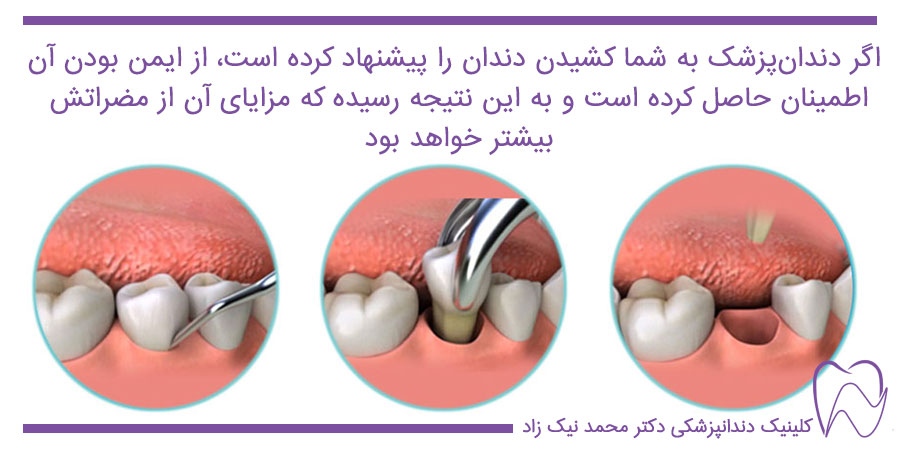 مراحل کشیدن دندان
