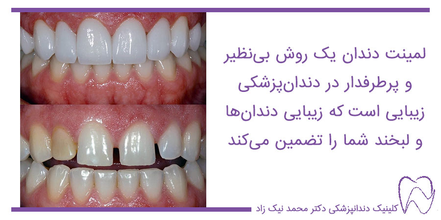 عکس قبل و بعد از لمینت دندان