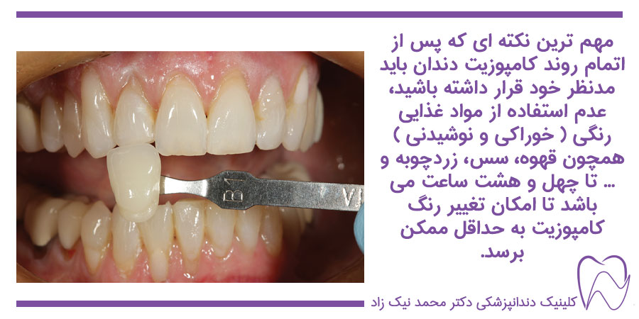 مراقبت از کامپوزیت دندان
