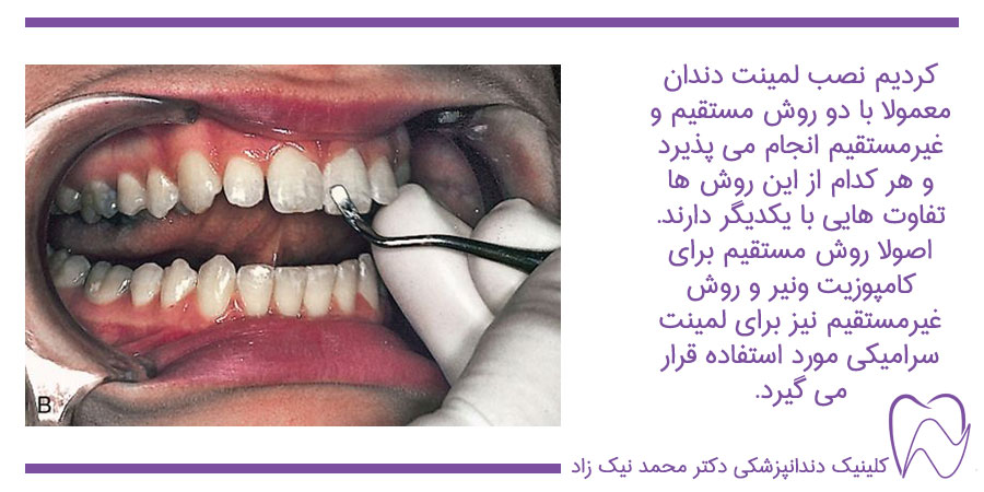 روش نصب لمینت دندان