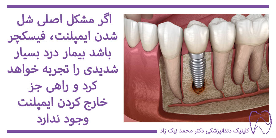 لق شدن ایمپلنت دندان بر اثر عفونت