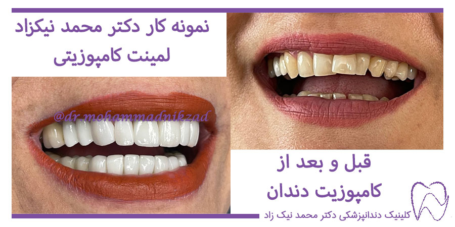 عکس قبل و بعد از لمینت کامپوزیتی دندان
