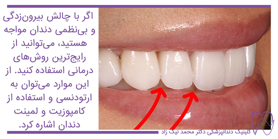 درمان بیرون زدگی دندان
