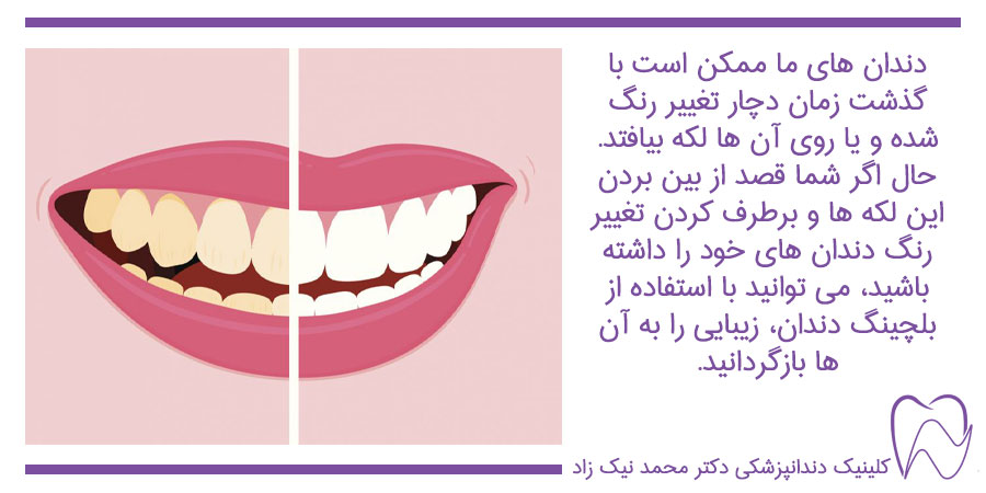 بلچینگ دندان