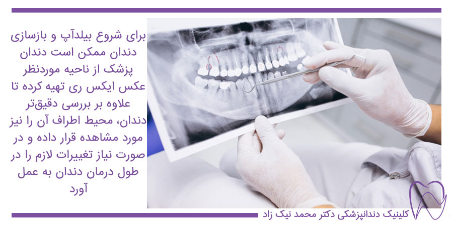 ممکن است دندان پزشک از ناحیه موردنظر عکس ایکس ری تهیه کرده تا علاوه بر بررسی دقیق تر دندان، محیط اطراف آن را نیز مورد مشاهده قرار داده و در صورت نیاز تغییرات لازم را در طول درمان دندان به عمل آورد.