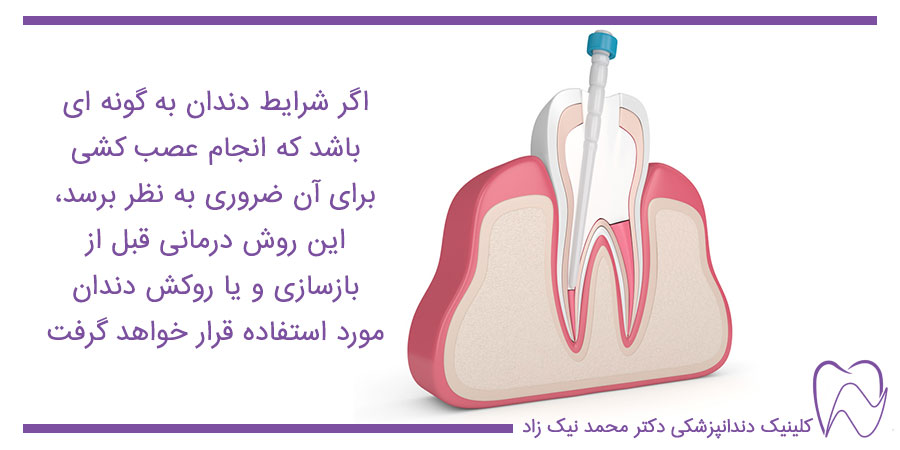 اگر شرایط دندان به گونه ای باشد که انجام عصب کشی برای آن ضروری به نظر برسد، این روش درمانی قبل از بازسازی و یا روکش دندان مورد استفاده قرار خواهد گرفت