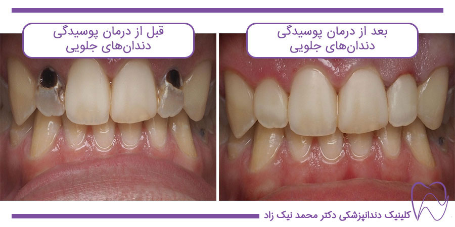 قبل و بعد از درمان دندان‌‌های جلویی پوسیده