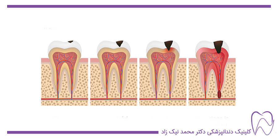 4 سطح از شروع پوسیدگی دندان‌ها-ابتدا در مینای دندان سپس عاج دندان-پوسیدگی به پالپ دندان رسیده و در مرحله اخردندان دچار آبسه میشود