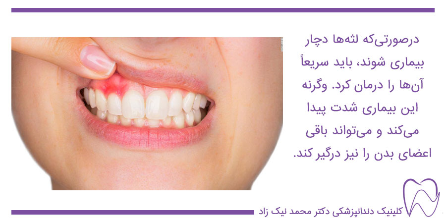 دندانهای زن جوانی که لثه های بالایی دچار التهاب و جمع شدن خون شده اند