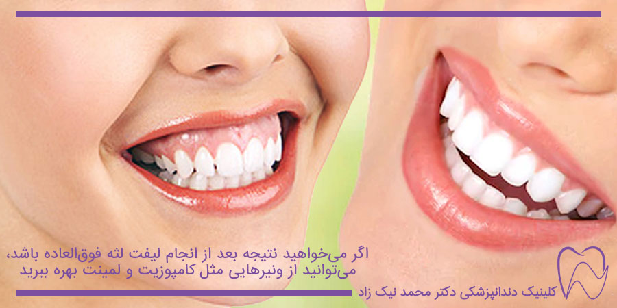 نتیجه قبل و بعد از جراحی لیفت لثه و استفاده از ونیرهای دندان
