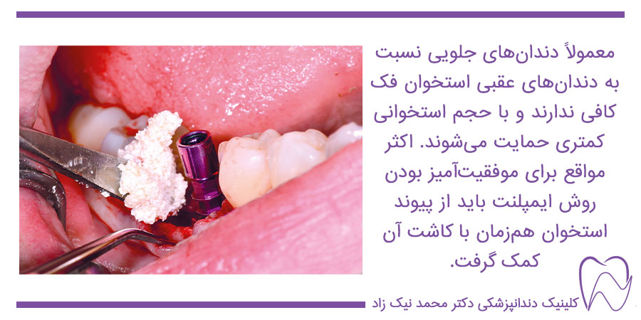 پیوند استخوان فک برای ایمپلنت دندان