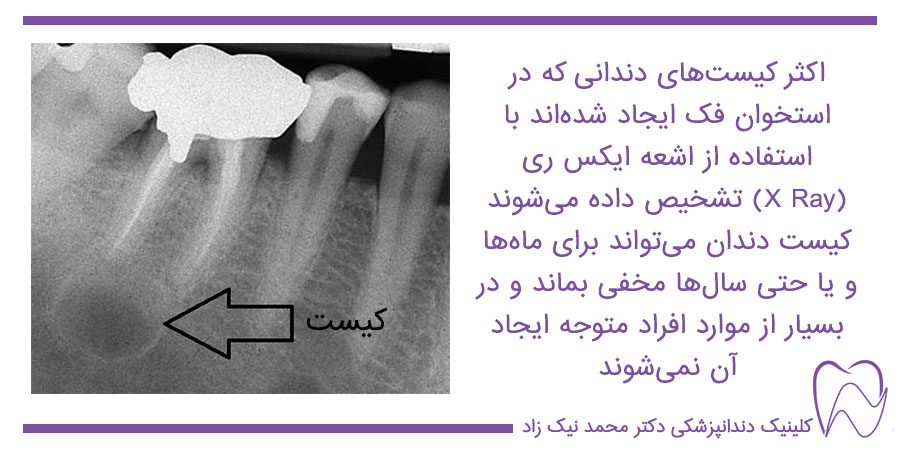 کیست دندان به وسیله عکس ایکس ری تشخی داده می‌شود