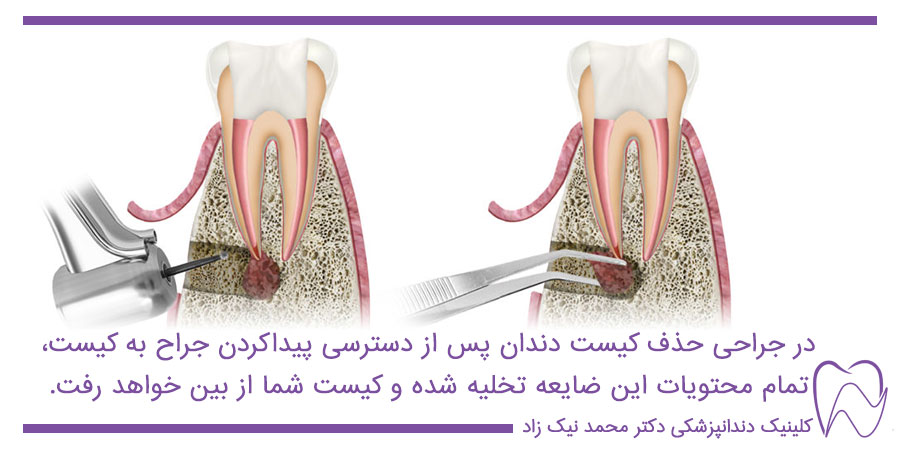 جراحی کیست دندان