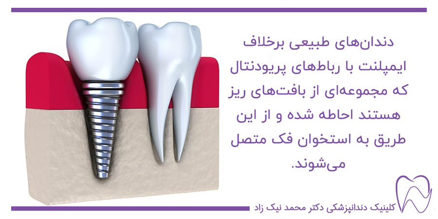 تفاوت دندان طبیعی با ایمپلنت