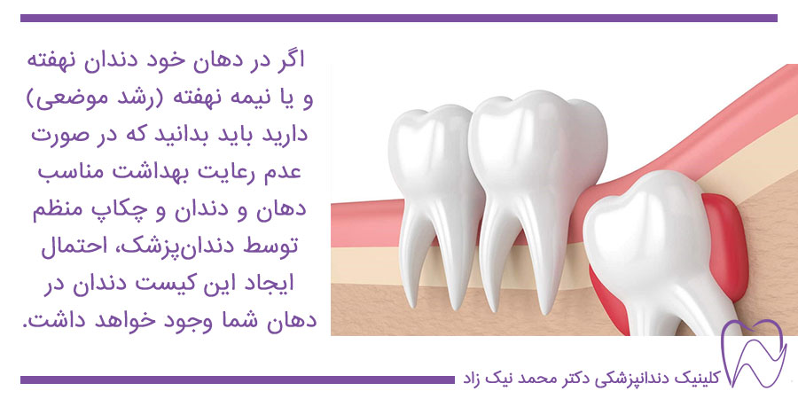 کیست دندان به علت وجود دندان نهفته