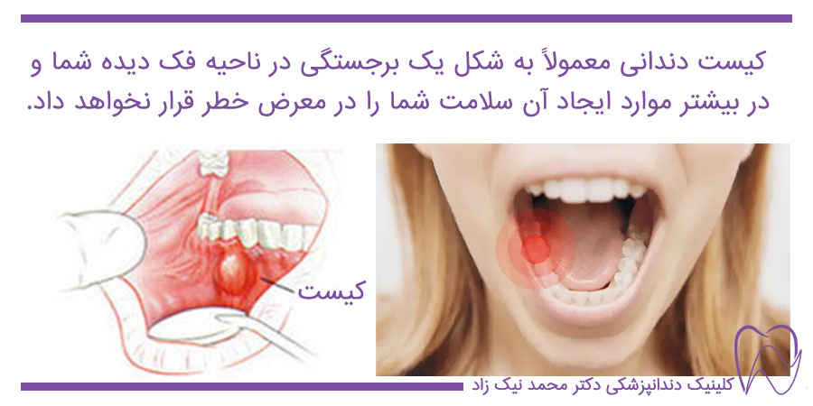 کیست دندانی همراه با درد