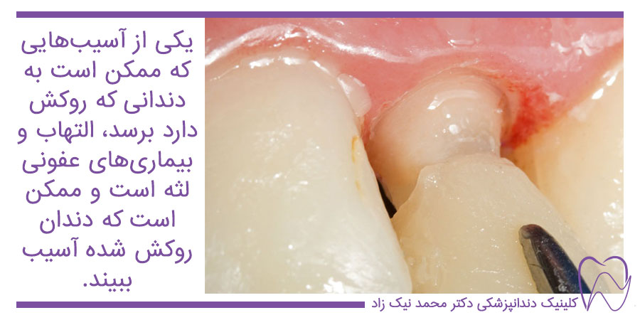 التهاب زیر روکش دندان