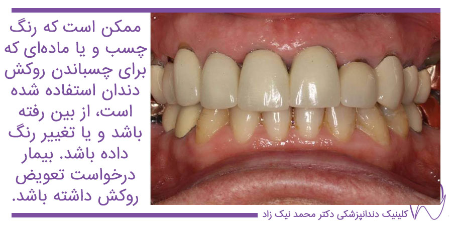 تعویض روکش دندان