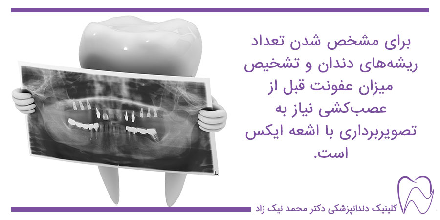 عکس opg برای تشخیص مشکلات دندان
