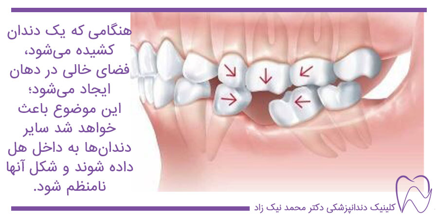 عوارض کشیدن دندان