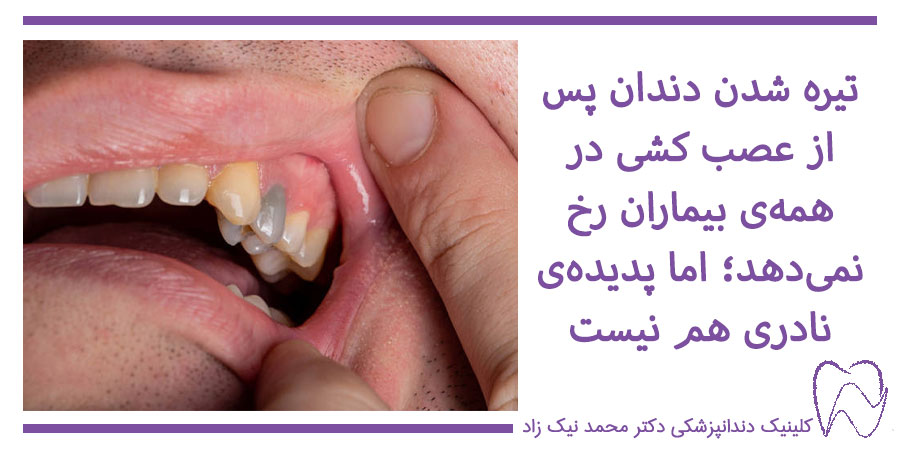 تیره شدن دندان بعد از عصب کشی