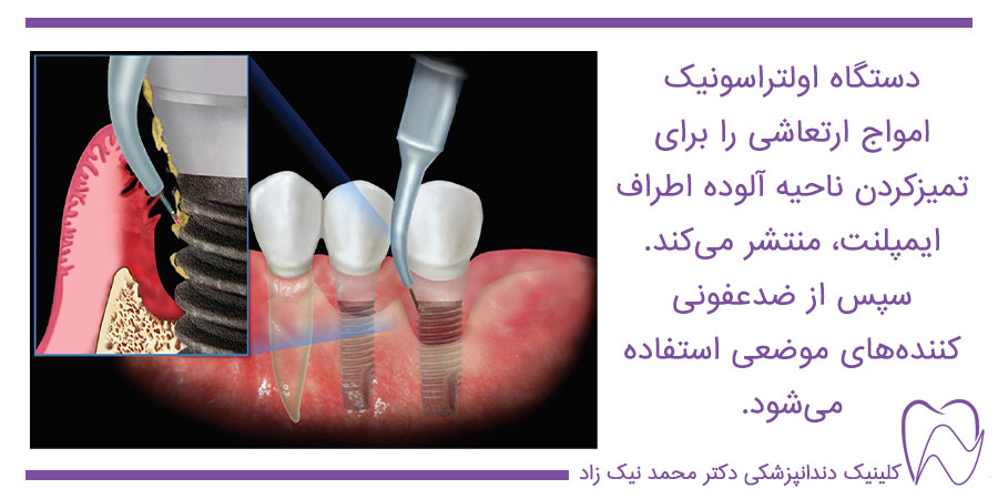 از بین بردن عفونت ایمپلنت دندان